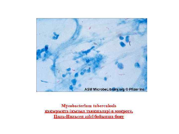 Mycobacterium tuberculosis қақырықта (қызыл таяқшалар) в мокроте. Циль-Нильсен әдісі бойынша бояу 