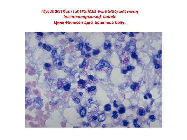 Mycobacterium tuberculosis өкпе жасушасының (клеткаларының) ішінде Циль-Нильсен әдісі бойынша бояу. 