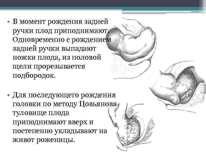  • В момент рождения задней ручки плод приподнимают. Одновременно с рождением задней ручки