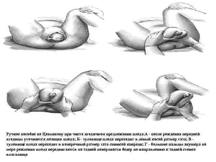 Ручное пособие по Цовьянову при чисто ягодичном предлежании плода. А - после рождения передней