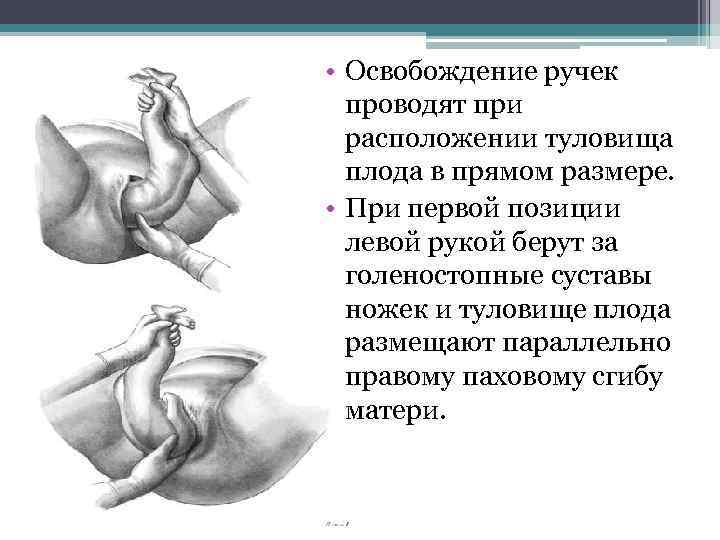  • Освобождение ручек проводят при расположении туловища плода в прямом размере. • При