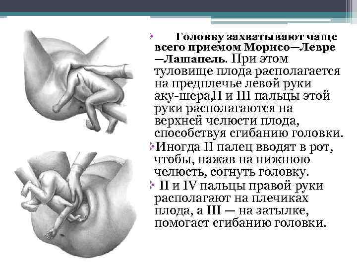 v Головку захватывают чаще всего приемом Морисо—Левре —Лашапель. При этом туловище плода располагается на