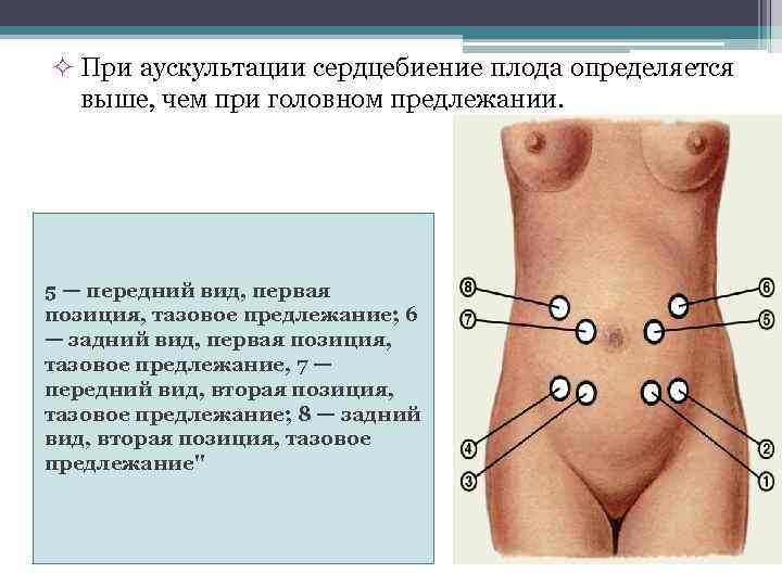 ² При аускультации сердцебиение плода определяется выше, чем при головном предлежании. 5 — передний