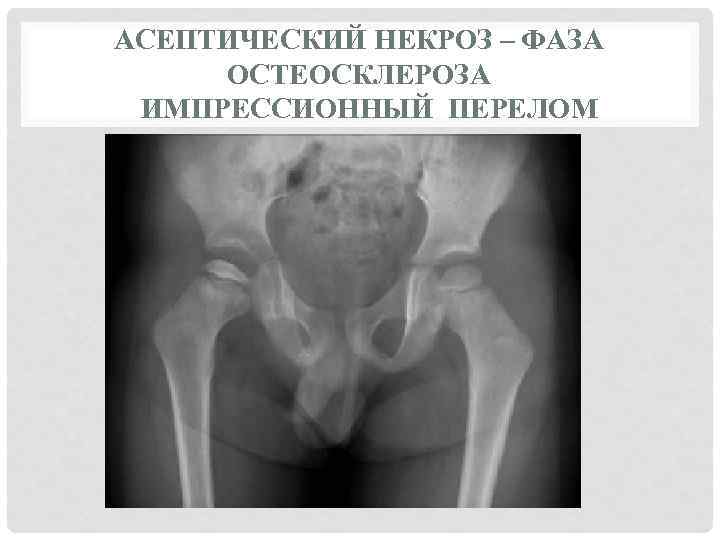 АСЕПТИЧЕСКИЙ НЕКРОЗ – ФАЗА ОСТЕОСКЛЕРОЗА ИМПРЕССИОННЫЙ ПЕРЕЛОМ 