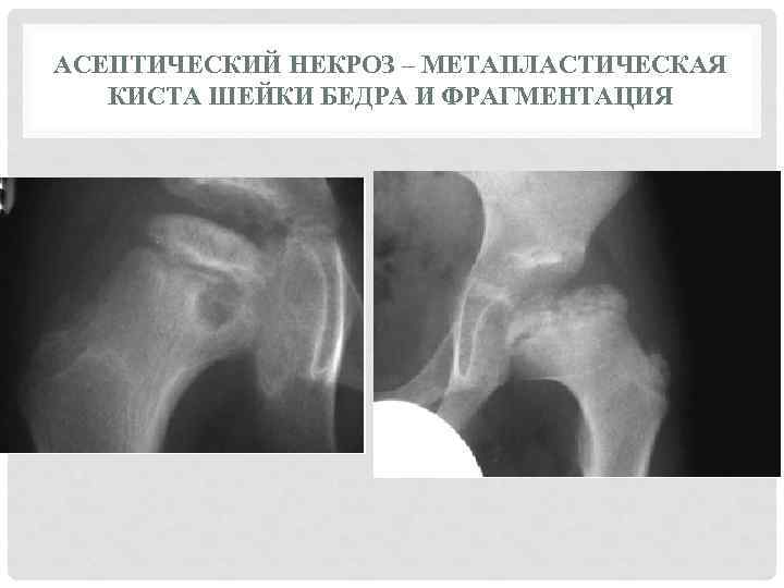 Мкб асептический некроз головки бедренной кости