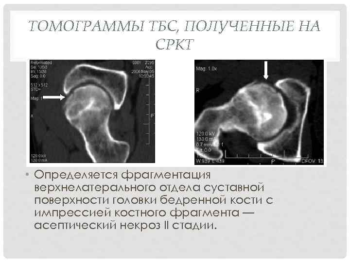 Импрессионный перелом головки бедренной кости