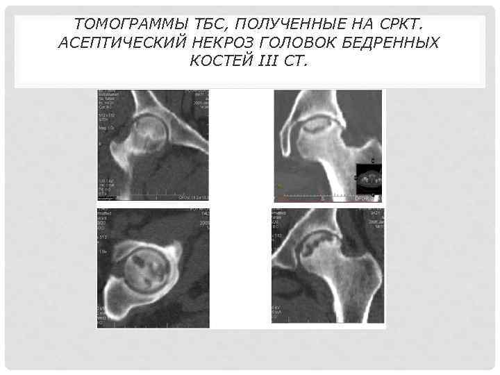 Стадии асептического некроза головки бедренной