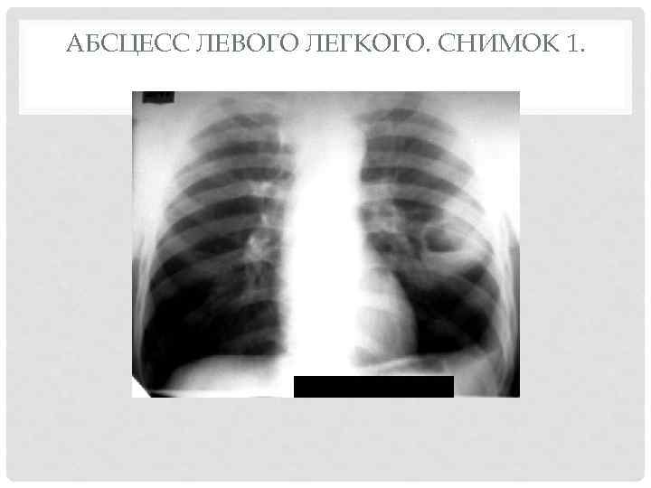 АБСЦЕСС ЛЕВОГО ЛЕГКОГО. СНИМОК 1. 