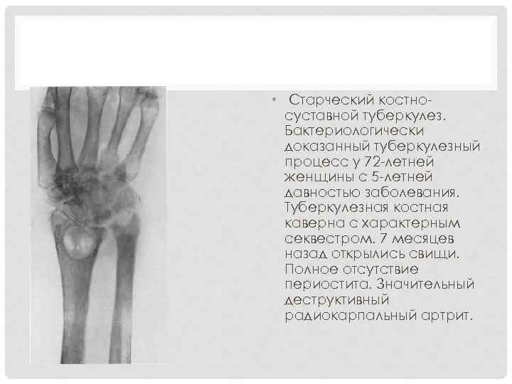  • Старческий костно суставной туберкулез. Бактериологически доказанный туберкулезный процесс у 72 летней женщины