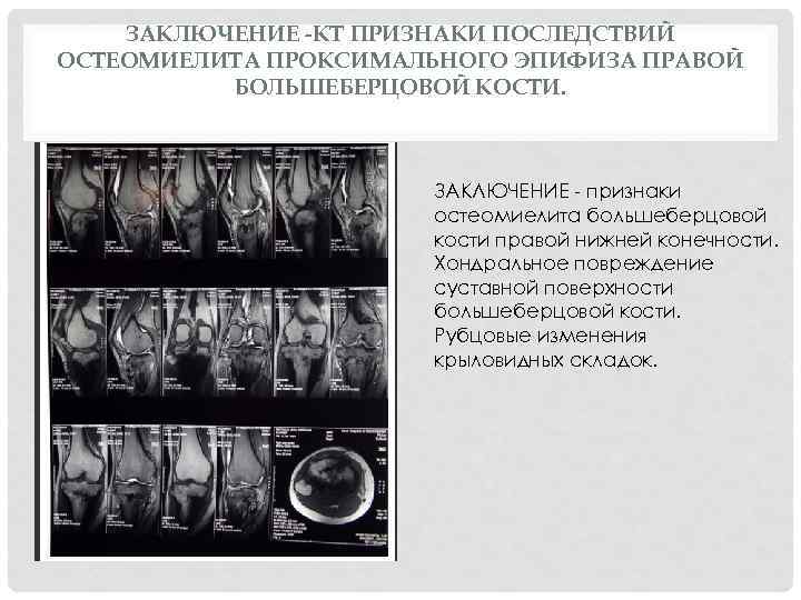 ЗАКЛЮЧЕНИЕ -КТ ПРИЗНАКИ ПОСЛЕДСТВИЙ ОСТЕОМИЕЛИТА ПРОКСИМАЛЬНОГО ЭПИФИЗА ПРАВОЙ БОЛЬШЕБЕРЦОВОЙ КОСТИ. ЗАКЛЮЧЕНИЕ признаки остеомиелита большеберцовой