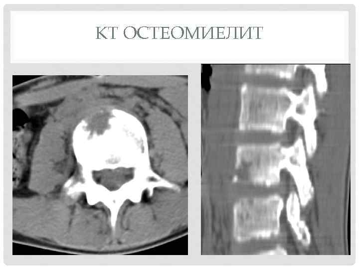 Остеомиелит свищ фото