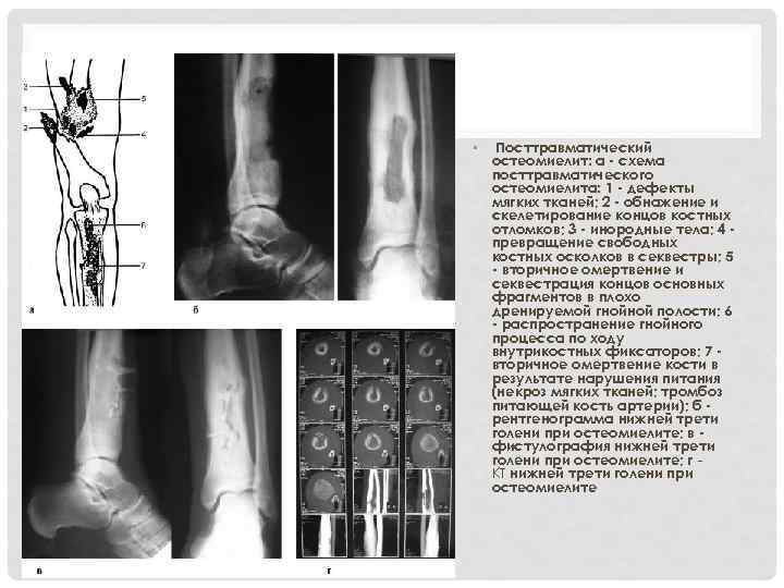Посттравматический остеомиелит фото