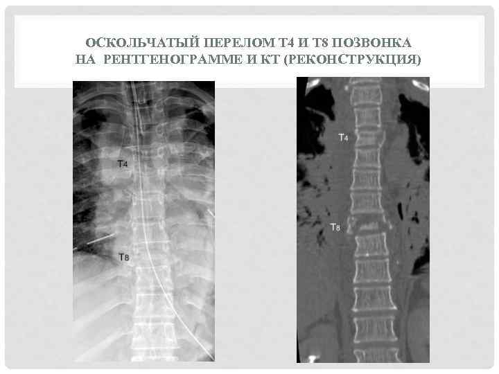 Рентген грудного отдела что показывает