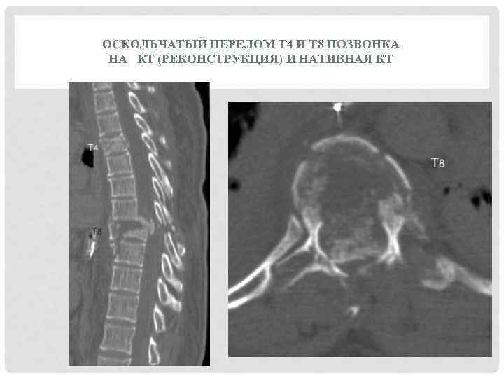 Оскольчатый перелом. Оскольчатый перелом тела позвонка на кт. Компрессионно-оскольчатый перелом тела l1 позвонка на кт. Компрессионно оскольчатый перелом позвоночника кт. Компрессионный оскольчатый перелом позвоночника l1.