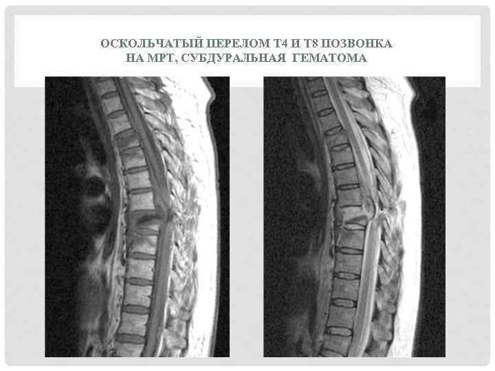 Перелом грудных позвоночников. Компрессионный перелом th11 позвонка. Компрессионно оскольчатый перелом позвоночника. Компрессионный оскольчатый перелом позвоночника l1. Компрессионный оскольчатый перелом 11 позвонка.