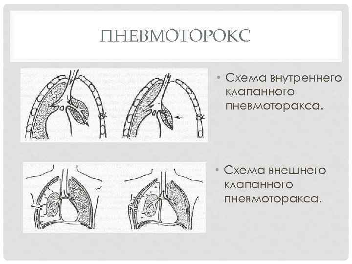 Клапанный пневмоторакс