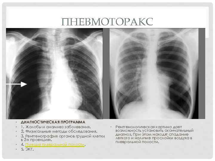 Пневмоторакс лучевая диагностика презентация