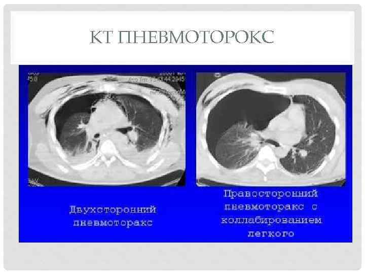 КТ ПНЕВМОТОРОКС 