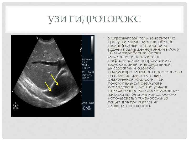 УЗИ ГИДРОТОРОКС • Ультразвуковой гель наносится на правую и левую нижнюю область грудной клетки,