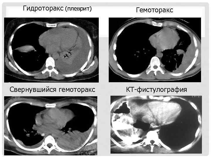 Гидроторакс (плеврит) Свернувшийся гемоторакс Гемоторакс КТ-фистулография 