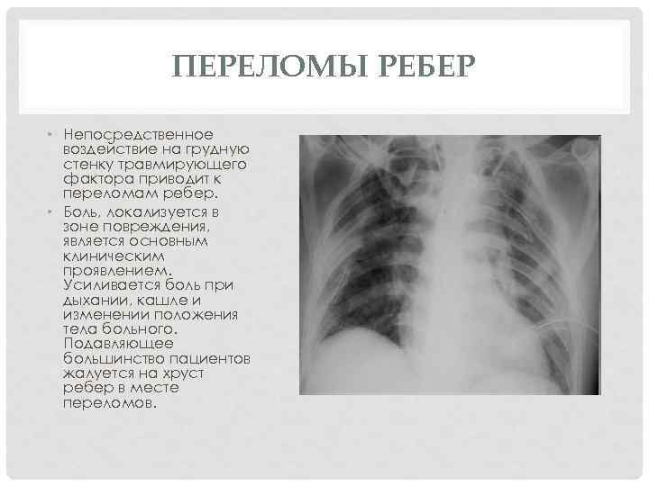 Множественные переломы ребер карта вызова