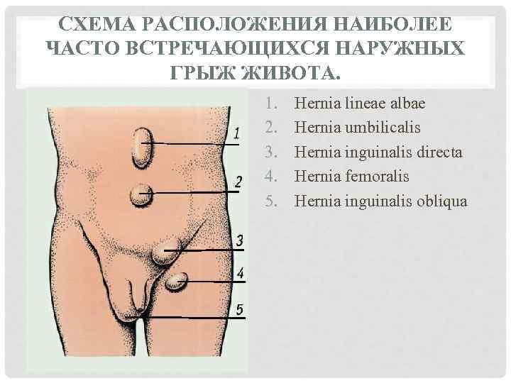 СХЕМА РАСПОЛОЖЕНИЯ НАИБОЛЕЕ ЧАСТО ВСТРЕЧАЮЩИХСЯ НАРУЖНЫХ ГРЫЖ ЖИВОТА. 1. 2. 3. 4. 5. Hernia