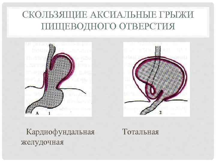 СКОЛЬЗЯЩИЕ АКСИАЛЬНЫЕ ГРЫЖИ ПИЩЕВОДНОГО ОТВЕРСТИЯ Кардиофундальная желудочная Тотальная 