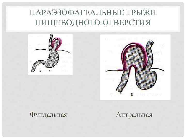 ПАРАЭЗОФАГЕАЛЬНЫЕ ГРЫЖИ ПИЩЕВОДНОГО ОТВЕРСТИЯ Фундальная Антральная 