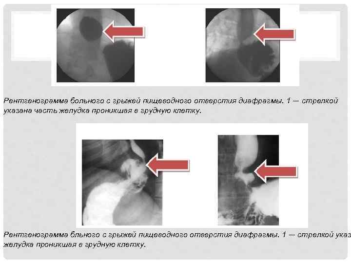 Эндоскопическая картина при грыжах пищеводного отверстия диафрагмы характеризуется