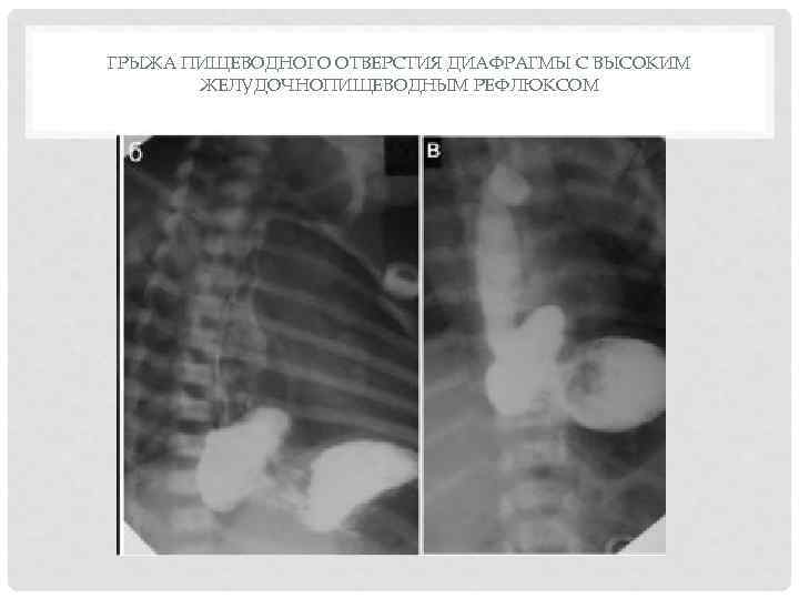 ГРЫЖА ПИЩЕВОДНОГО ОТВЕРСТИЯ ДИАФРАГМЫ С ВЫСОКИМ ЖЕЛУДОЧНОПИЩЕВОДНЫМ РЕФЛЮКСОМ 