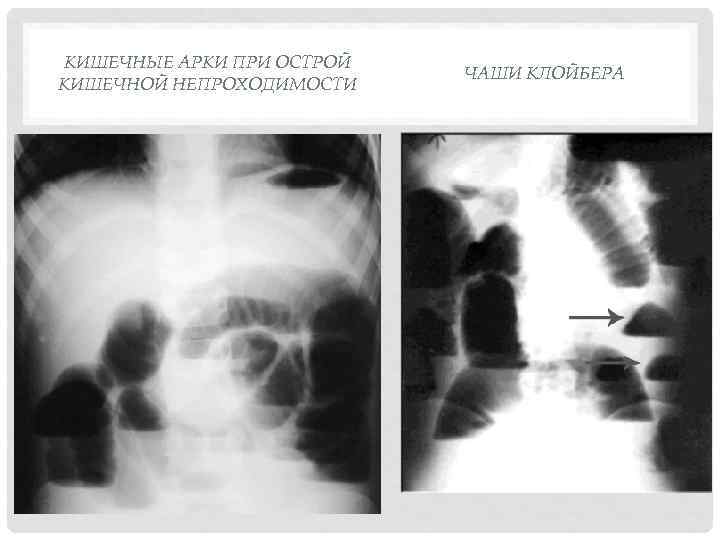 КИШЕЧНЫЕ АРКИ ПРИ ОСТРОЙ КИШЕЧНОЙ НЕПРОХОДИМОСТИ ЧАШИ КЛОЙБЕРА 