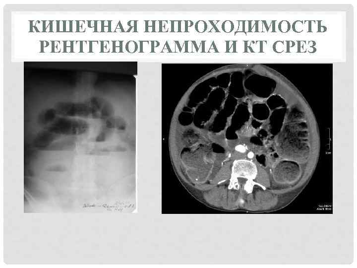 КИШЕЧНАЯ НЕПРОХОДИМОСТЬ РЕНТГЕНОГРАММА И КТ СРЕЗ 