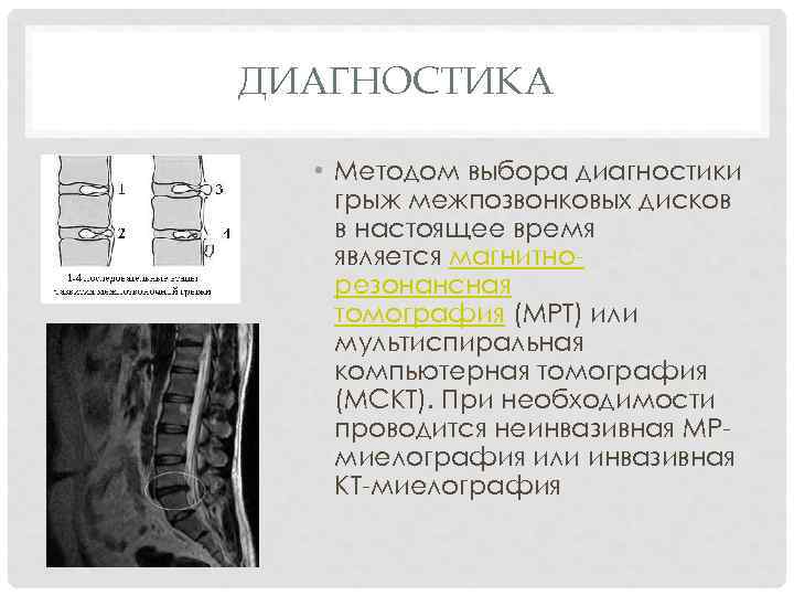 ДИАГНОСТИКА • Методом выбора диагностики грыж межпозвонковых дисков в настоящее время является магнитнорезонансная томография