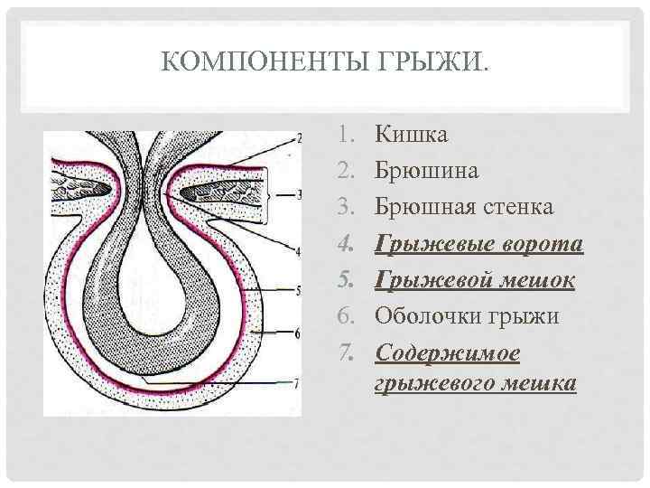 Пупочная грыжа рисунок схема