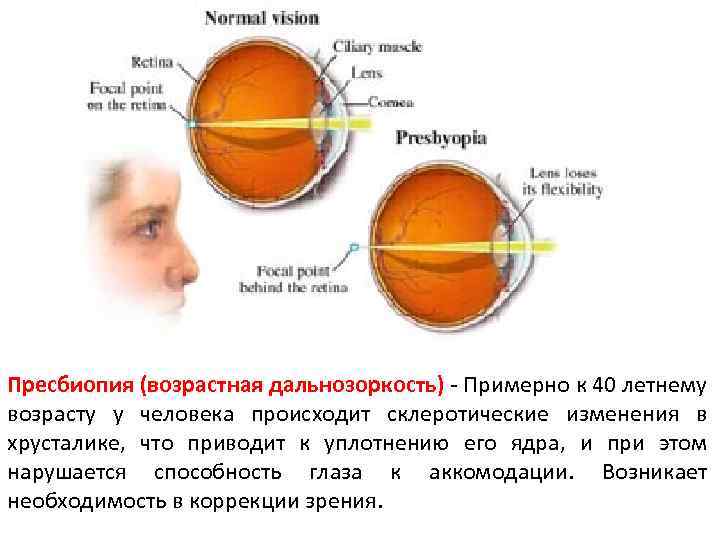 Пресбиопия это. Пресбиопия. Возрастная дальнозоркость. Возрастная пресбиопия. Изменения хрусталика при пресбиопии.