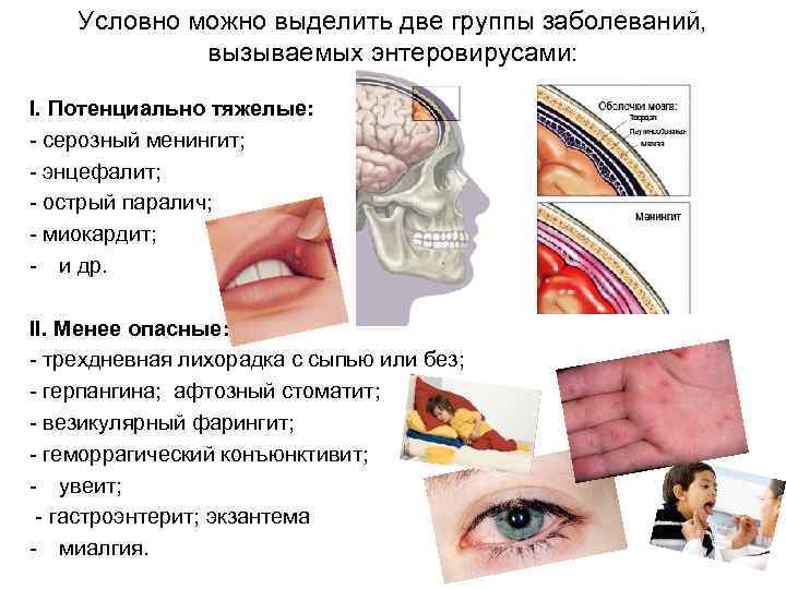 Условно можно выделить две группы заболеваний, вызываемых энтеровирусами: I. Потенциально тяжелые: - серозный менингит;