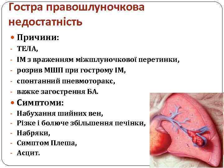 Гостра правошлуночкова недостатність Причини: - ТЕЛА, - ІМ з враженням міжшлуночкової перетинки, - розрив