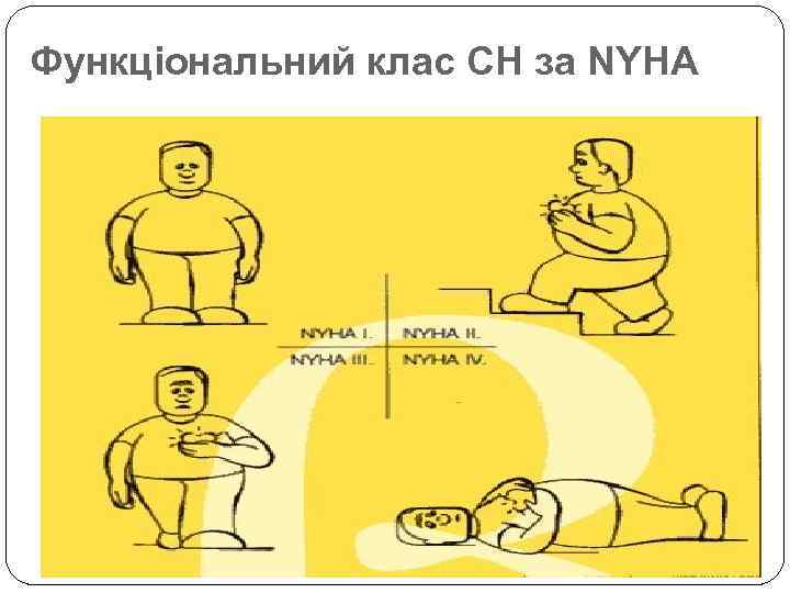 Функціональний клас СН за NYHA 