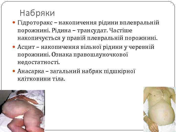 Набряки Гідроторакс – накопичення рідини вплевральній порожнині. Рідина – трансудат. Частіше накопичується у правій