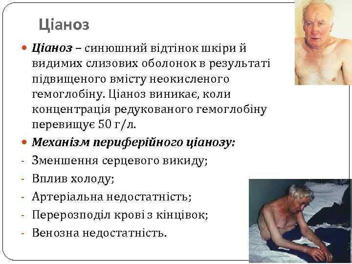 Ціаноз – синюшний відтінок шкіри й - видимих слизових оболонок в результаті підвищеного вмісту