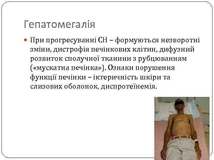 Гепатомегалія При прогресуванні СН – формуються незворотні зміни, дистрофія печінкових клітин, дифузний розвиток сполучної