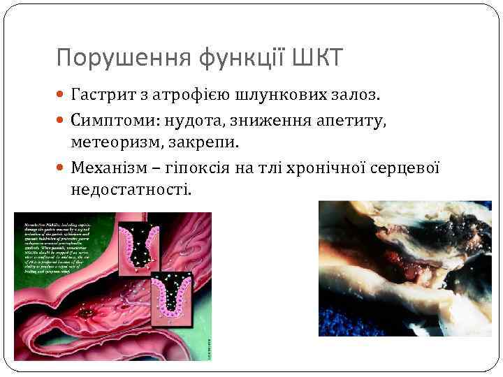Порушення функції ШКТ Гастрит з атрофією шлункових залоз. Симптоми: нудота, зниження апетиту, метеоризм, закрепи.