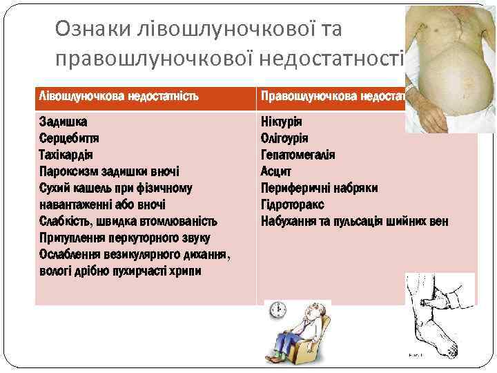 Ознаки лівошлуночкової та правошлуночкової недостатності Лівошлуночкова недостатність Правошлуночкова недостатність Задишка Серцебиття Тахікардія Пароксизм задишки