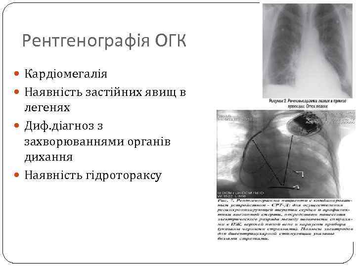 Рентгенографія ОГК Кардіомегалія Наявність застійних явищ в легенях Диф. діагноз з захворюваннями органів дихання
