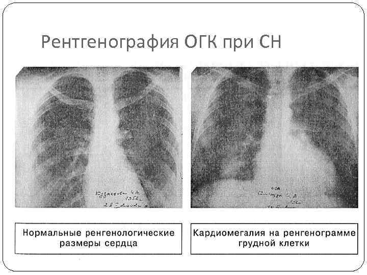 Рентгенография ОГК при СН 
