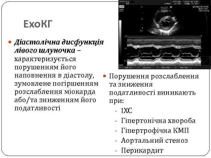 Ехо. КГ Діастолічна дисфункція лівого шлуночка – характеризується порушенням його наповнення в діастолу, Порушення