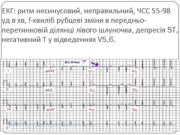 ЕКГ: ритм несинусовий, неправильний, ЧСС 55 -98 уд в хв, f-хвиліб рубцеві зміни в