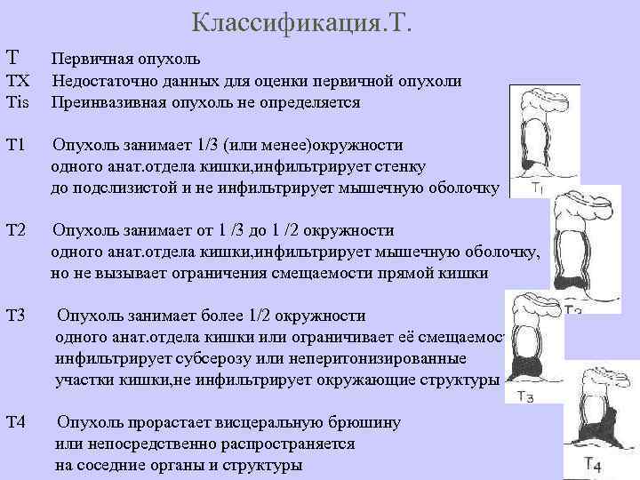 Классификация. Т. Т Первичная опухоль ТХ Недостаточно данных для оценки первичной опухоли Тis Преинвазивная