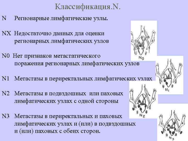 Классификация. N. N Регионарные лимфатические узлы. NХ Недостаточно данных для оценки регионарных лимфатических узлов