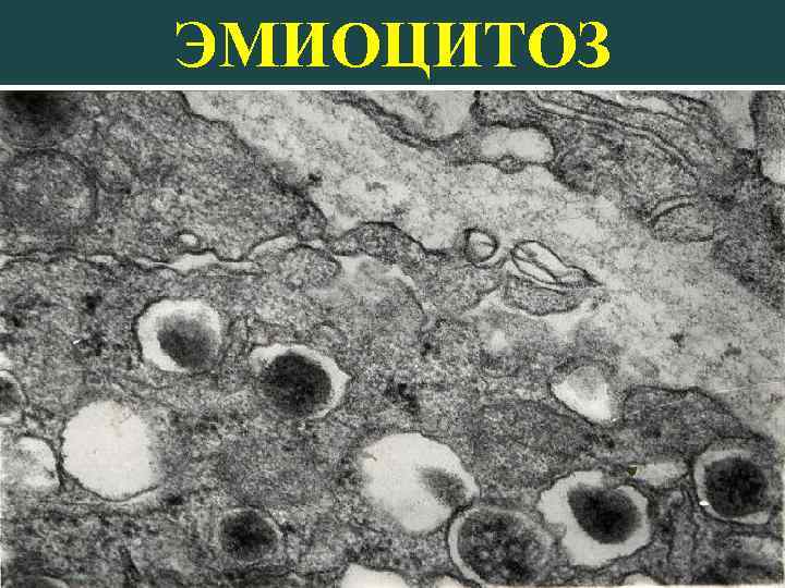 ЭМИОЦИТОЗ 